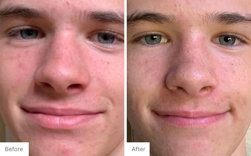 5 - Before and After Real Results photo of a man's use of Neora's Acne Complexion Treatment Pads